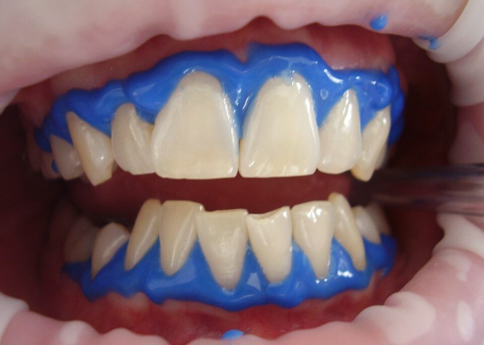 teeth-whitening-960x684