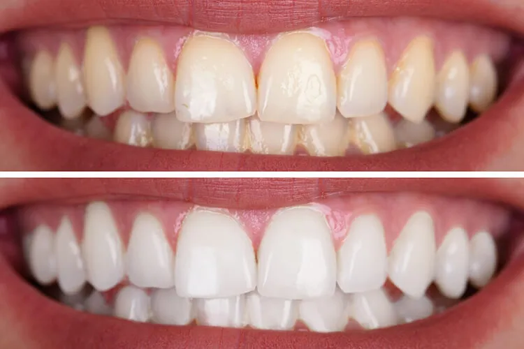 teeth-whitening-before-and-after